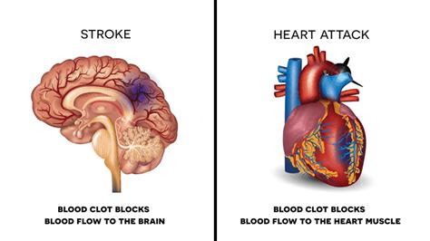 Avoid A Heart Attack or Stroke: 10 Foods to Never Ignore