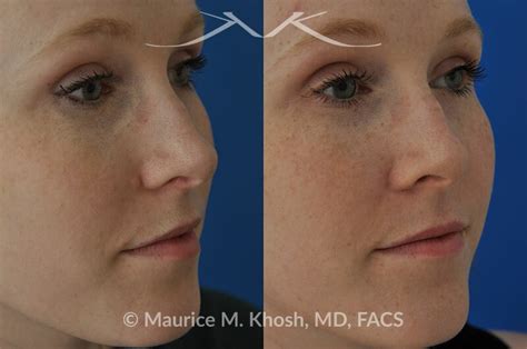 New York Facial Plastic Surgery Skin Laceration Repair / Mole removal Before and After Pictures