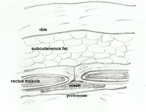 Diagram showing the positioning of the mesh in the preperitoneal space ...