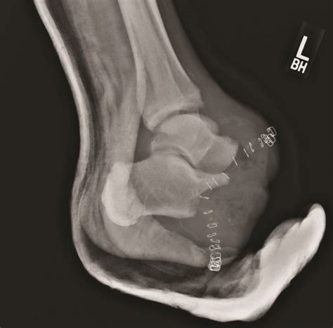 Achieving Optimal Offloading After A Chopart Amputation