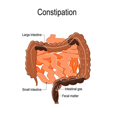 Constipation Treatment Atlanta | Piedmont Colorectal Associates