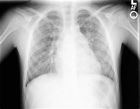 Atrial septal defect chest x ray - wikidoc