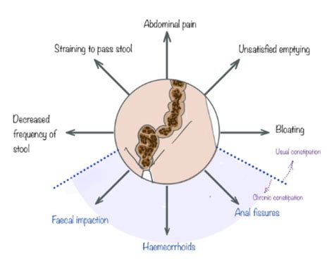 Constipation Causes, Symptoms, Risks, Treatment | Cape Town