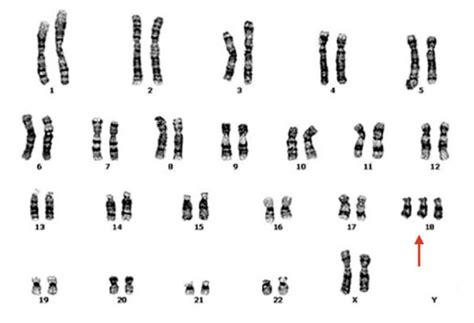 Trisomy 18- Definition, Symptoms, Pictures, Diagnosis And Life Expectancy