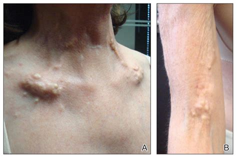 Dystrophic Calcinosis Cutis: Treatment With Intravenous Sodium ...