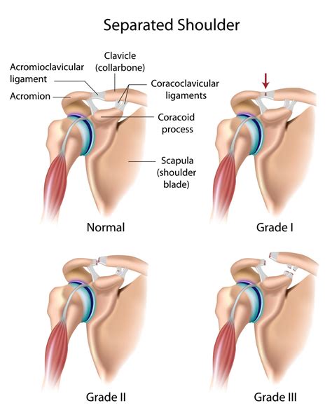 Shoulder Separation (AC Separation)