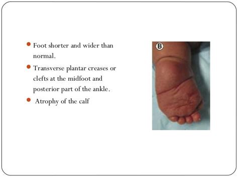 CONGENITAL TALIPES EQUINOVARUS