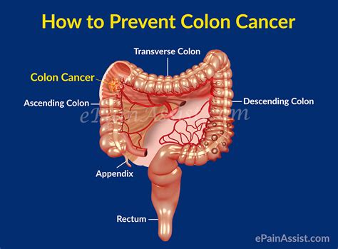 Colon Cancer or Cancer of the Colon|Survival Rate|Recurrence|Prevention ...