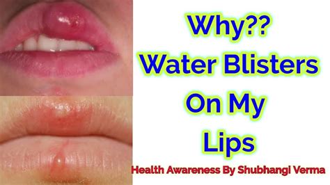 Water Blisters On Your Lips | Lipstutorial.org