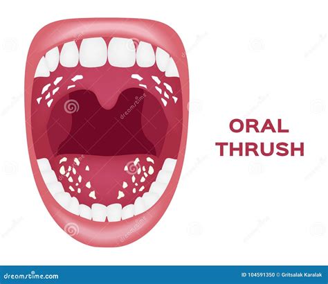 Oral thrush . white tongue stock vector. Illustration of closeup ...