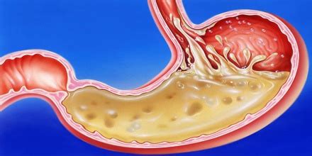 Gastric Acid - Assignment Point