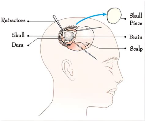 Craniotomy - Types, Indications, Procedure, Complications