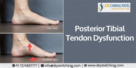 Posterior Tibial Tendon Dysfunction |Treating Fallen Arches