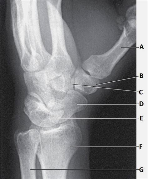 PA Oblique Wrist Diagram | Quizlet