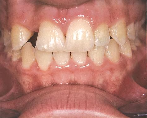 Use of a Resin-Bonded Bridge to Replace a Congenitally Missing Lateral Incisor: Treatment of ...