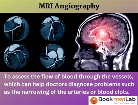 MRI Angiography Price, Purpose, Procedure, Results [2024]