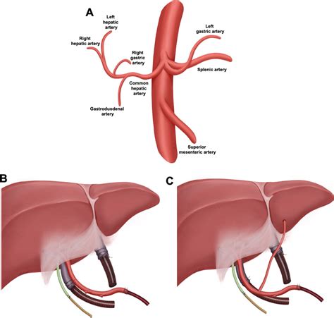 Celiac Artery Diagram