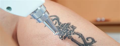 Easy And Safe Tattoo Removal