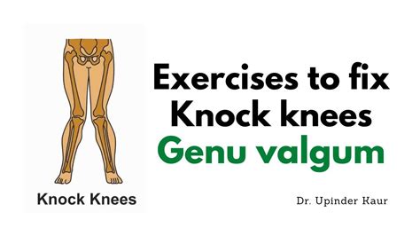 Exercises to fix Knock knees | Genu valgum - YouTube