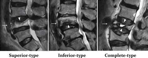 Preoperative MRI images showing the three types of burst fracture... | Download Scientific Diagram