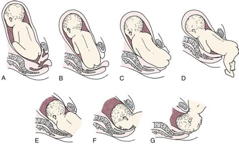 Labor and Birth Complications | Nurse Key