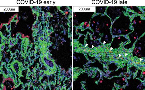 Detailed Map of COVID-19 Lung Pathology Revealed With Advanced Technology