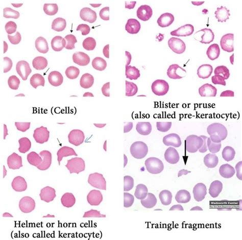 Abnormal Red Blood Cells Morphology and Possible Causes | Medical ...