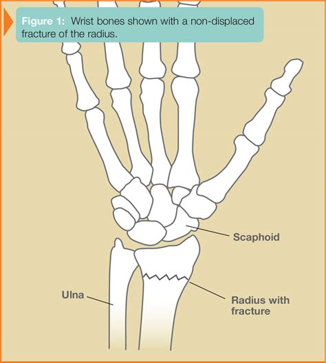 Wrist Fractures | Ocean Orthopedic Associates