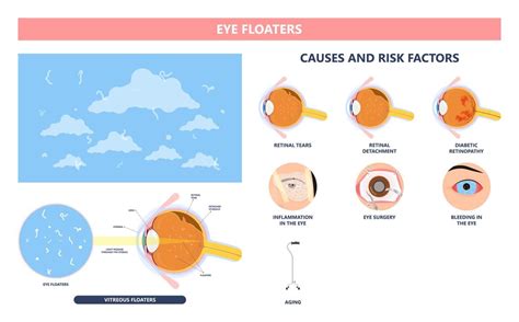 Empowering Choices: Unveiling the Spectrum of Vision Enhancement Methods