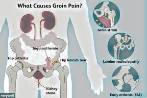 Causes of groin pain in males - PT Master Guide