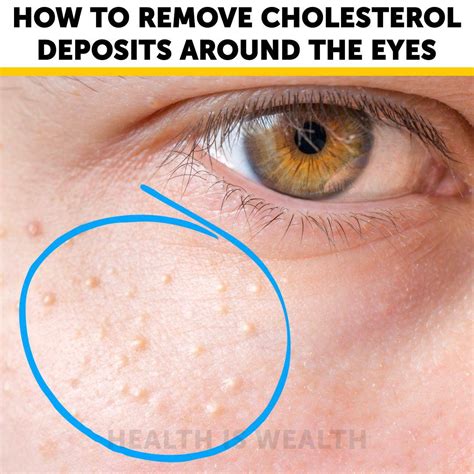 How to remove cholesterol deposits around the eyes: | By Now I've Seen Everything