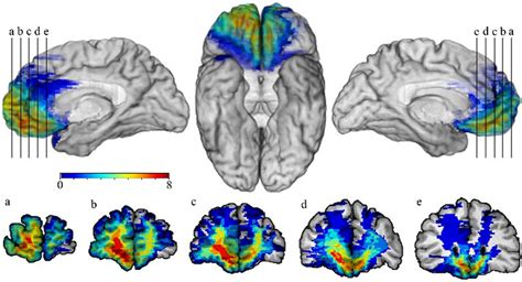 Ventromedial Prefrontal Cortex And Orbitofrontal Cortex