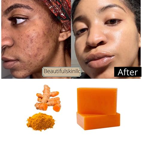 Turmeric Kojic Bar Soap Dark Spots Remover Acne Remover - Etsy | Skin ...