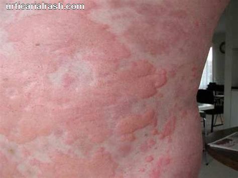 red rashes on skin - pictures, photos