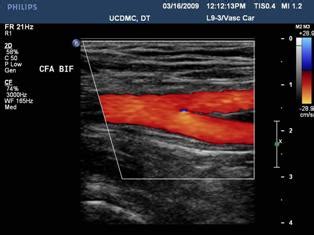 Peripheral Arterial Duplex Scanning | Vascular Center| UC Davis Health