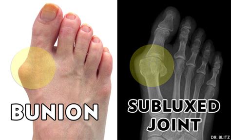 10 Most Common Bunion Surgery Questions - huffingtonpost