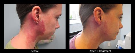 Laser Birthmark Removal: Remove Birthmarks, Port Wine Stains - Connecticut Skin Institute