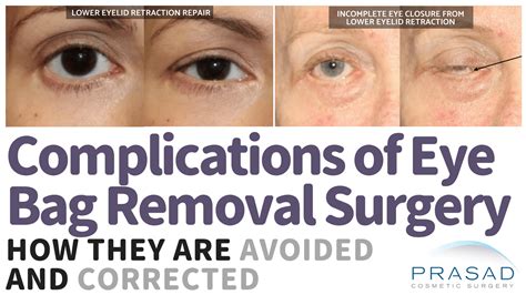 Eye Bag Removal Surgery: Procedure, Risks, Recovery