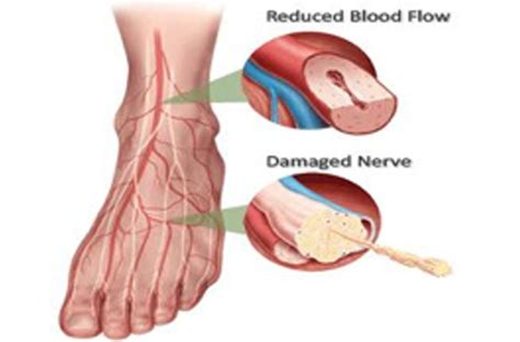 Nerve Ischiadicus (Nerve Problem)