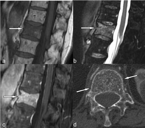 Atypical Hemangioma Spine Mri