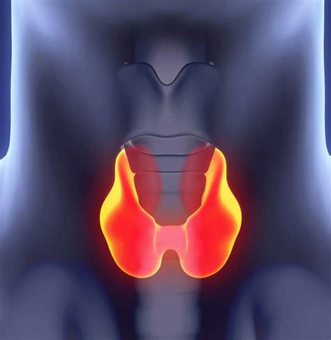 Early signs of medullary thyroid cancer and common symptoms