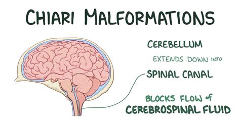 Chiari malformation: Video, Anatomy & Definition | Osmosis