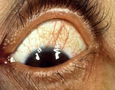 Causes, Signs, Symptoms and Tips to Overcome Dry Eyes ...