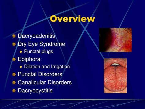 PPT - Lacrimal System Disorders PowerPoint Presentation, free download - ID:4399406