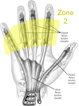 Flexor Tendon Injuries - Hand - Orthobullets