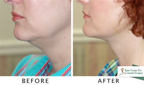 Neck Lift St. Petersburg / Clearwater - Dr. Lawrence Kass