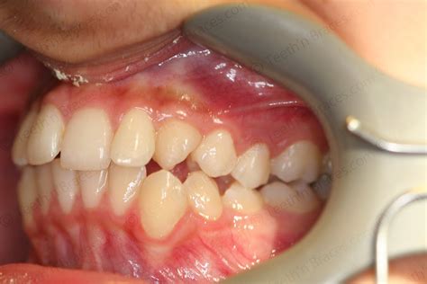 Case 29: Irregular and protruded Teeth | Teeth N Braces