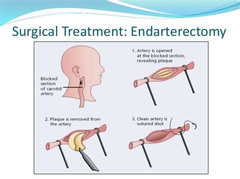 Carotid Artery Stenosis Treatment Options