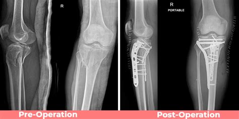 Complex Proximal Tibia Fracture » Delhi Institute of Trauma & Orthopaedics