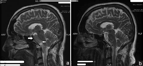 Surgical Neurology International